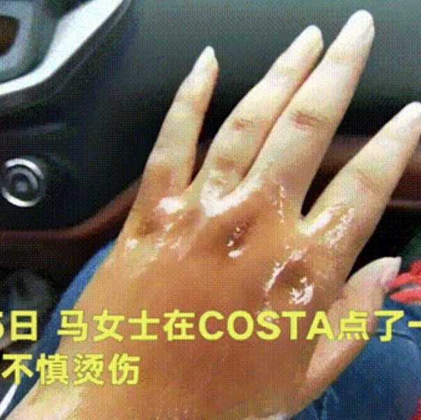 COSTA顧客被燙傷懷疑茶具設(shè)計缺陷？大家平常喝熱飲的時候，要非常注意！